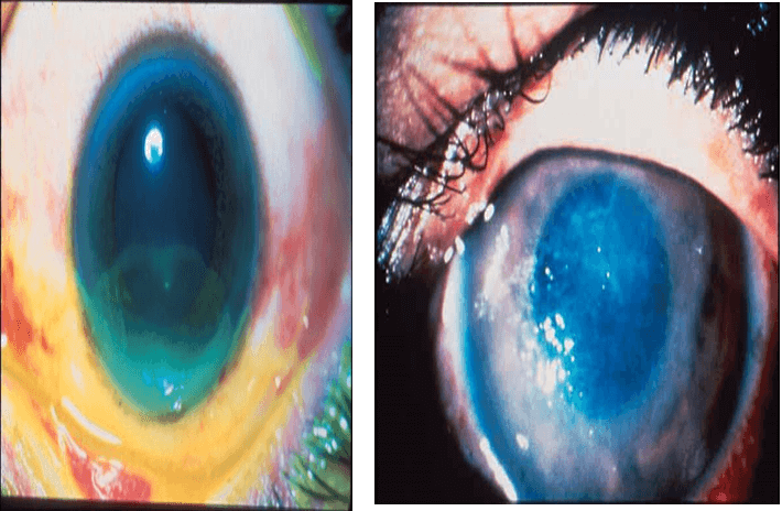 cyanide chemical eye injury